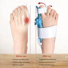 Adjustable Bunion Support Splint – Hallux Valgus Corrector for Men & Women